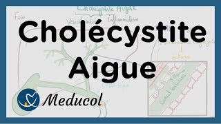 Cholécystite aiguë inflammation vésicule biliaire symptômes colique biliaire et cholécystectomie [upl. by Tala]