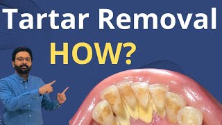 Tartar Removal from Teeth  Dental Teeth Cleaning [upl. by Philbo]