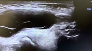 Ultrasound of Hydrocele of cord in 2 year child [upl. by Merriam]