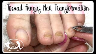 Pedicure Tutorial Thinning Thick Toenail Fungus Nail Transformation 🔴✔️ [upl. by Cedric]