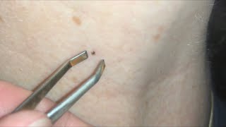 How to remove a tick with tweezer and lighter tick removal DIY [upl. by Lindon740]