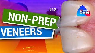 Nonprep veneers BG Dental Cases 12 [upl. by Dinse41]