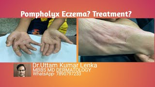 What is pompholyx eczema reason and Treatment of itchy vesiclesblisters on palms and soles [upl. by Icken]