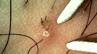 Plucking Hair and Blackheads with Tweezers [upl. by Enived299]