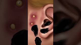 Ear cleaning ear pimple blackhead cleaning animation AMSR animation asmr shorts short [upl. by Leatri]