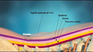 La stimulation souscutanée dans le traitement de la lombalgie chronique [upl. by Eiramanig]