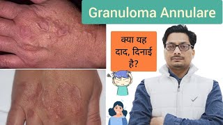 Granuloma Annulare  क्या यह दाद दिनाई है ringworm tinea दाद दिनाई ringwormtreatment fungus [upl. by Odlonra]