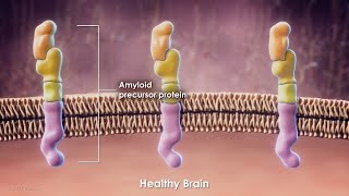 Current Treatments and Research for Alzheimers Disease [upl. by Flatto]