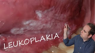 Leukoplakia Common Oral Pathology [upl. by Eenalem]