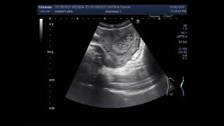 Ultrasound Video showing Hydatidiform mole also called Molar pregnancy [upl. by Amaryllis]