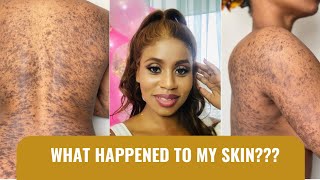 What happened to my skin Lichenplanus [upl. by Carder]