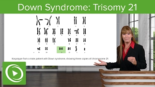 Down Syndrome Trisomy 21 – Medical Genetics  Lecturio [upl. by Butler]