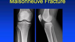 Ankle Trauma Advanced Anatomy Imaging amp Classification [upl. by Dwan581]