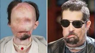 Man shows off first US full face transplant [upl. by Yatnoj]