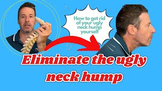 Eliminate the ugly neck hump by yourself in just 510 minutes per day [upl. by Noivad624]