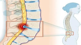 Causas y síntomas de la discopatía degenerativa [upl. by Hulton1]
