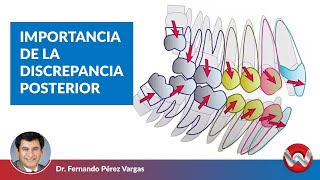 Importancia de la discrepancia posterior en su planificación de tratamiento [upl. by Clemmie164]