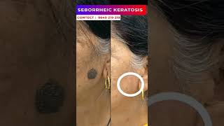 Seborrheic Keratosis treatment at Skinaa clinic viralshorts serborrheickeratosis skinaaclinic [upl. by Willcox176]