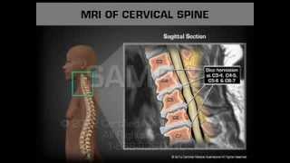 MRI of Cervical Spine [upl. by Nilyarg]