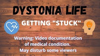 Dystonic storm  Paroxysmal Kinesogenic Dystonia quotGETTING STUCKquot [upl. by Macmahon]