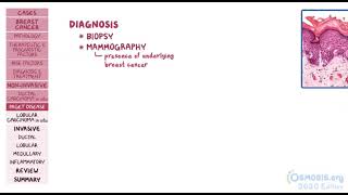 Breast cancer  Pathology review  Osmosis [upl. by Ardnuassac]