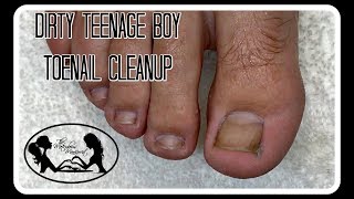 Pedicure How to Clean Dirty Teenage Boy Toenails [upl. by Haidabez]