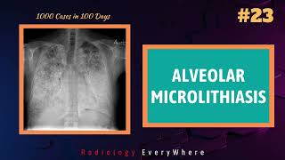 Pulmonary Alveolar Microlithiasis  Radiology Everywhere  1000 cases in 100 days  video 23 [upl. by Nettie]