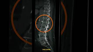 허리 통증의 숨겨진 원인 L1 압박 골절 바로 알기 L1 Compression Fracture Your Essential Guide to Spinal Health [upl. by Enitselec]