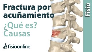 Fractura por acuñamiento vertebral ¿Que es y como sucede [upl. by Ynittirb709]