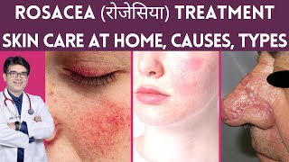 Rosacea Treatment Skin Care Laser Treatment  Rosacea का इलाज  Rosacea Causes Types  Hindi [upl. by Ednew]