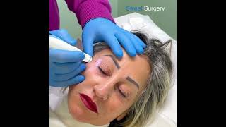 Nonsurgical Blepharoplasty fibroblasting blepharoplastic plasmalifting plasmapen [upl. by Pen]