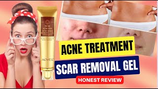 Aliver TCM Acne Treatment and Scar Removal Gel Ointment Cream ReviewAcne Scar Skin Repair [upl. by Leitman263]