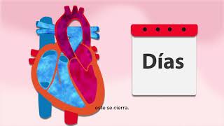 PERSISTENCIA DEL CONDUCTO ARTERIOSO PCA [upl. by Namreg]