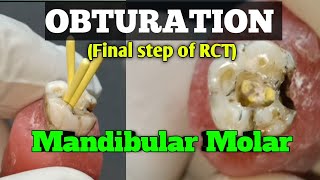 How to do obturation in mandibular molar  final step of RCT [upl. by Letrice]