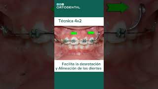 Tratamiento de un Incisivo Severamente Rotado bracket ortodoncialima ortodoncista lima dientes [upl. by Sayles]