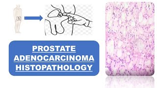 Prostate Adenocarcinoma Histopathology [upl. by Fiora921]