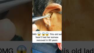 Ear Wax Removal 25 [upl. by Lotte173]