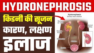 Hydronephrosis हाइड्रोनफ्रोसिस या क‍िडनी में सूजन के कारण लक्षण और इलाज  hydronephrosis treatment [upl. by Acinok602]