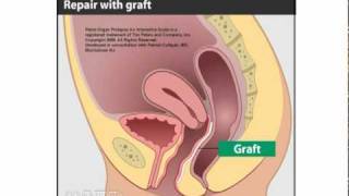 Surgical Treatment for Rectocele [upl. by Acirahs]