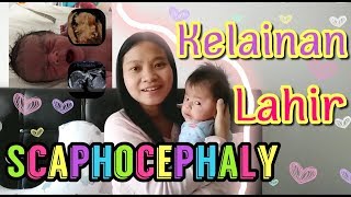 Kelainan lahir  Bayi Indonesia  Turki kepala jenong  SCAPHOCEPHALY [upl. by Ahsyia199]