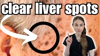 Get Rid Of Liver Spots FAST  Seborrheic Keratosis [upl. by Case]