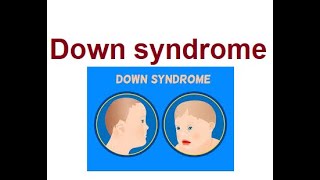 Understanding Down Syndrome Causes amp Treatments  2024 [upl. by Croydon]