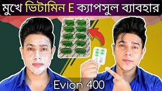 Evion 400 এর সাহায্যে মুখ ফর্সা এবং ব্রণ কমানোর 100  কার্যকরী সহজ উপায়  ভিটামিন ই ক্যাপসুল [upl. by Aronaele715]