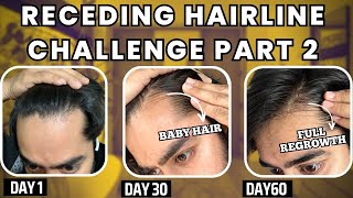 30 days HAIRLINE REGROWTH challenge PART 2  सिर्फ 1 महीने मैं RECEDING HAIRLINE REGROW करो [upl. by Zebaj451]