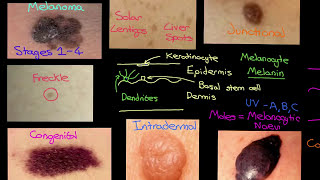 Melanocytic Lesions Part 3 [upl. by Anoek]