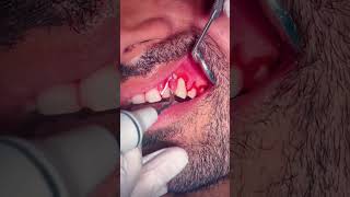 Bleeding gums treatment dentalprocedure dentistry dentalworld dentalcare dentalhealth scaling [upl. by Anwat]