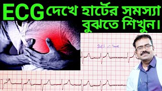 ECG দেখে হার্টের সমস্যা বুঝবেন কিভাবেHow to interpret ECGHow to read ECGElectrocardiogramECG [upl. by Vladimir]