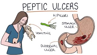 Symptoms of Gastric and Duodenal Ulcer [upl. by Ellinej559]