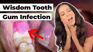 what does this SWOLLEN gum flap mean Pericoronitis Explained [upl. by Bent30]