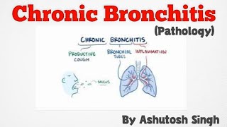 Chronic Bronchitis ll Respiratory Pathology [upl. by Airotnahs]